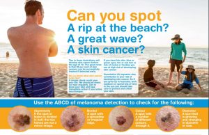 melanoma